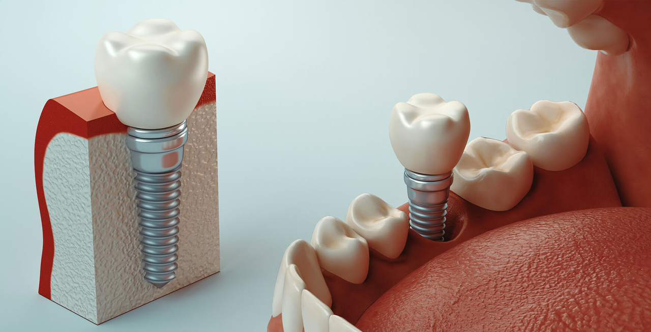 失った歯を補うインプラント埋入治療